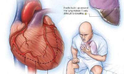 Ці 6 ознак можуть вказувати на розвиток серцевої недостатності у людини