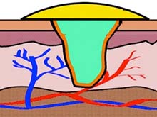 Вчені представили гель, що купірує найсильніші кровотечі