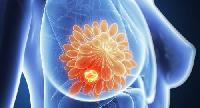 Зупиняє метастазування: виявили важливий фактор боротьби з раком