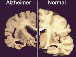 Простий аналіз крові виявить деменцію майже за 20 років до появи перших симптомів