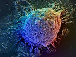 Вчені зрозуміли, чому при ожирінні рак грудей поводиться агресивніше