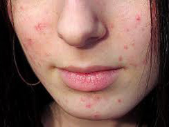 Акне може бути генетичною недугою, заявляють вчені