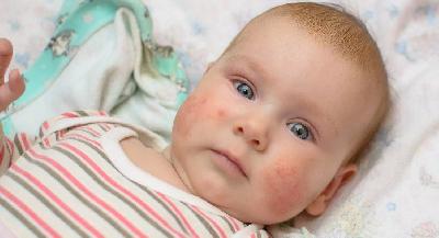 Знайшли нову причину атопічного дерматиту