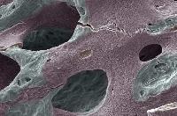 Американські вчені знайшли зв’язок між каменями в нирках та остеопорозом