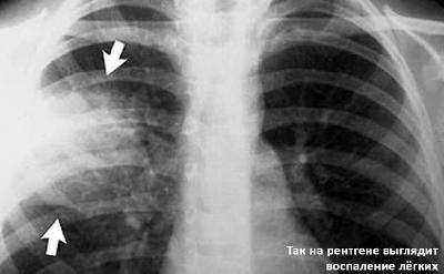 Вчені розкрили вплив коронавірусу на легені в перші години зараження